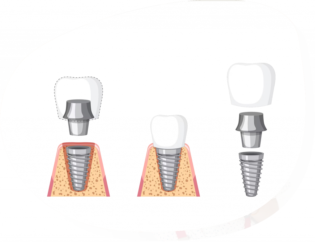 Dikişsiz implant yapılabilir mi ?