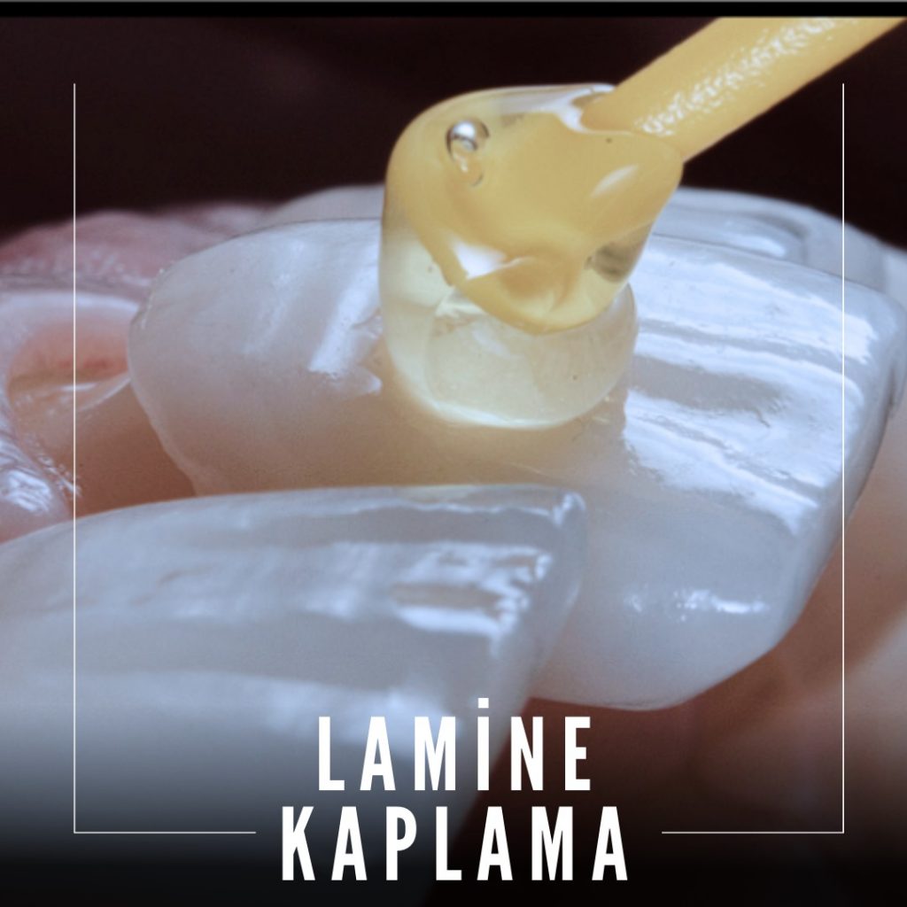 Lamine Diş Kaplamaları: Estetik ve Gülümsemenizi Yeniden Tanımlayın
